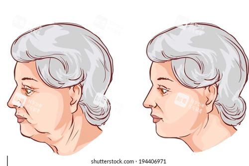 颈部拉皮卡通图