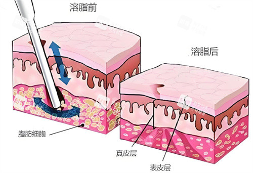 射频溶脂术皮肤层