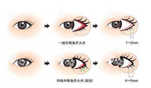 开外眼角手术过程