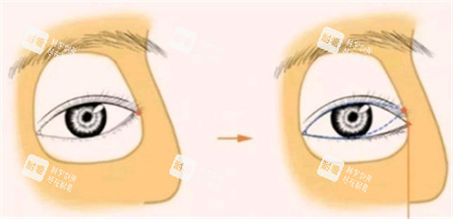 开外眼角手术设计图