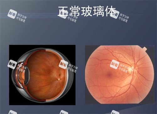 正常玻璃体图片