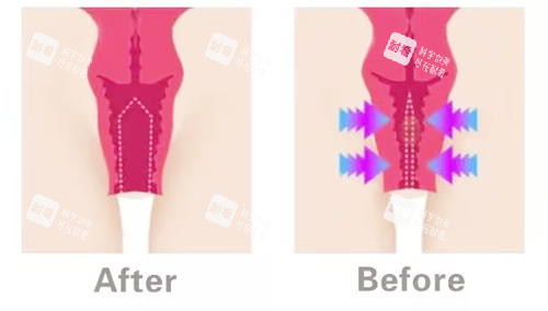 阴道紧缩对比图