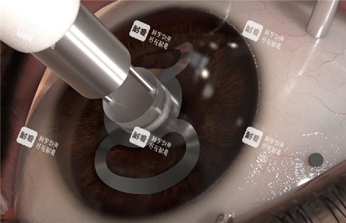 角膜移植手术模拟图