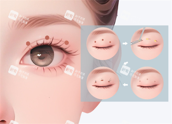 双眼皮整形卡通图片