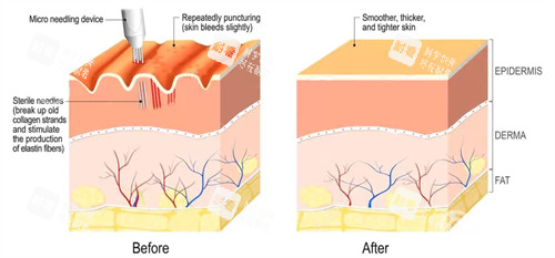凹陷疤痕填充前后对比图