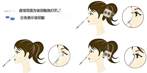 隆鼻玻尿酸部位图