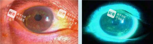 干眼症眼球图片