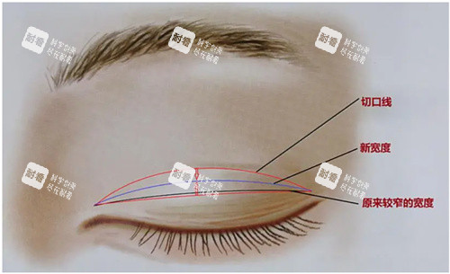 双眼皮肉条修复术原理