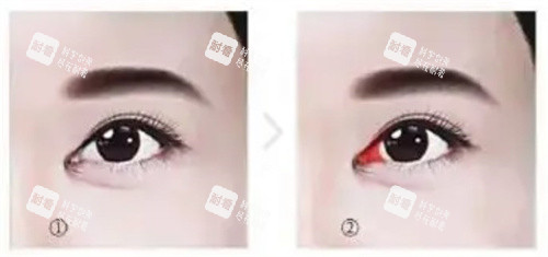 需要修复的内眼角