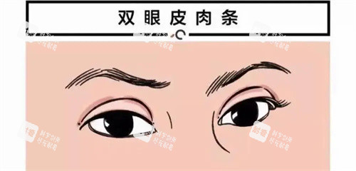 双眼皮肉条痕图
