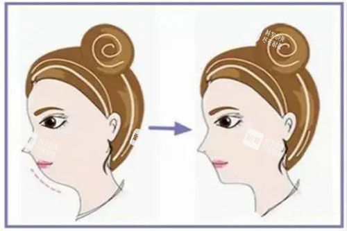 假体垫下巴侧面示意图