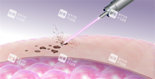 激光改善皮肤斑点