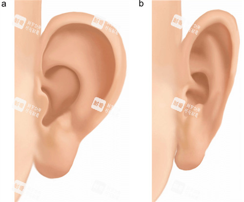 手术改善耳朵形状前后对比