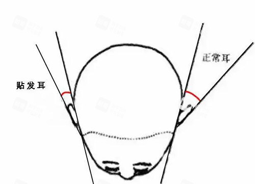 耳朵反骨内贴照片