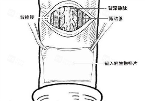 阴茎生物补片创口位置