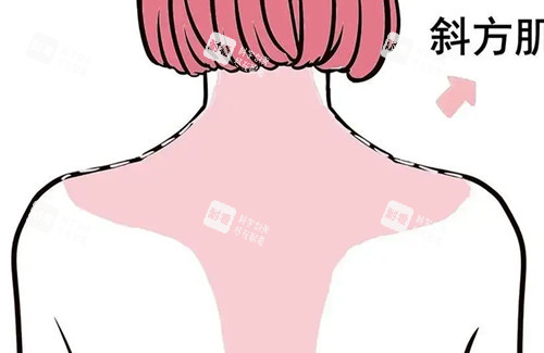 背部吸脂卡通示意图