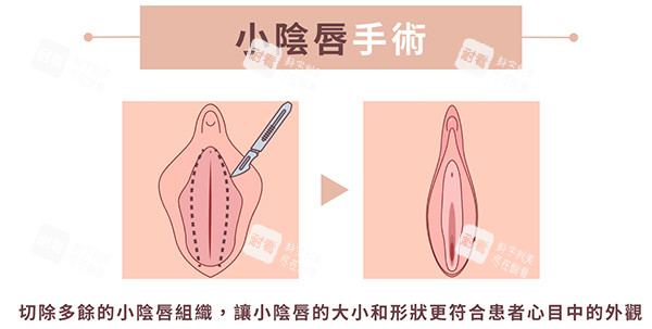小阴唇整形手术前后照片