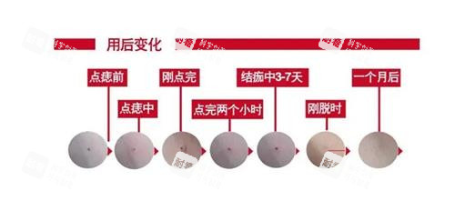激光去痣后的成效