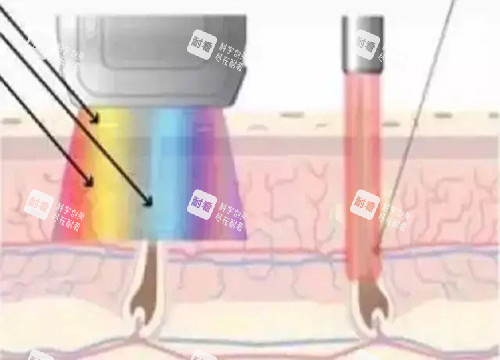 激光祛疤作用光波示意图