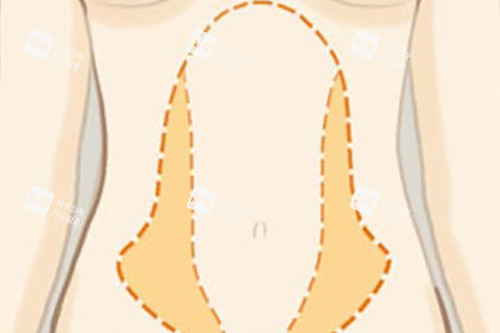 腰腹吸脂位置示意图