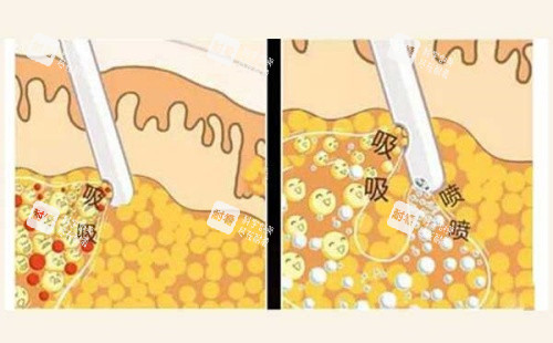 吸脂操作示意图