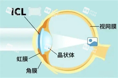 icl晶体植入术眼睛位置示意图