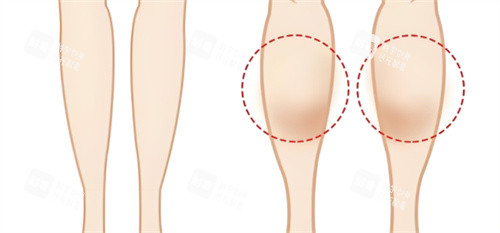 小腿肌肉图对比