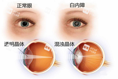 白内障与正常眼睛卡通对比图