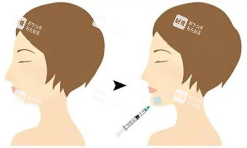 注射垫下巴前后的区别