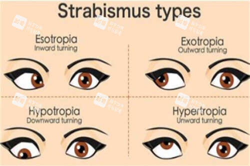 不同斜视对比图