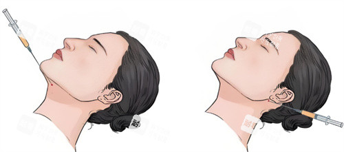 双下巴注射