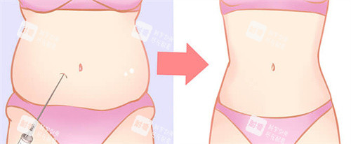 肚子吸脂前后对比