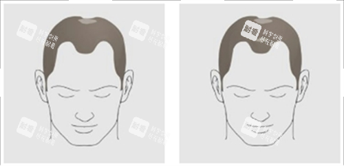 发际线及头顶头发脱落素材
