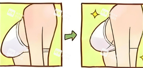 胸部缩小术前后对比动画图