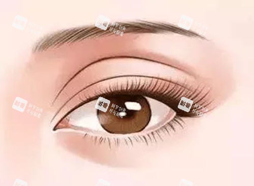 双眼皮修复卡通示意图