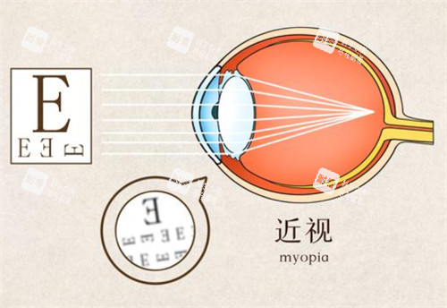 近视视物时的样子图解