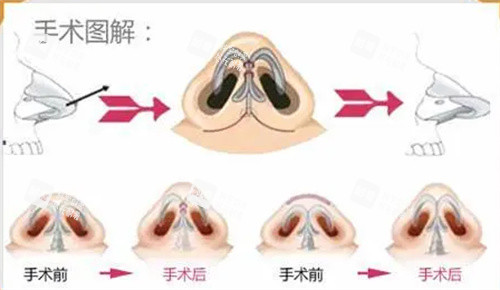 鼻翼手术细节图