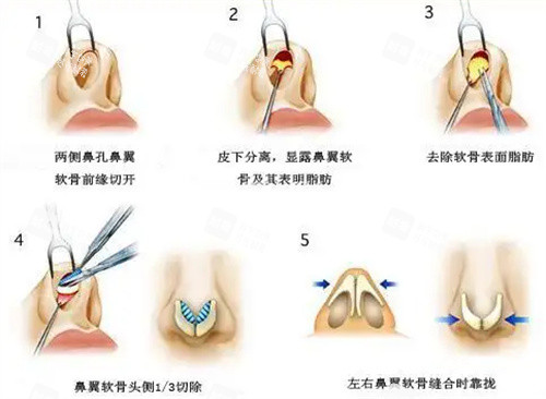 鼻翼手术步骤图