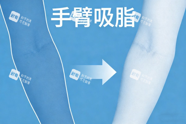 手臂做吸脂卡通图一览