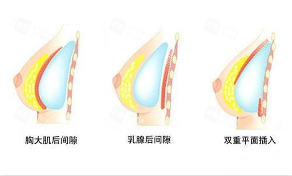 隆胸假体植入方式示意
