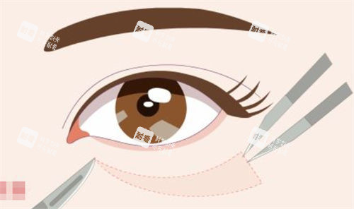 刷爆朋友圈的深圳去眼袋出名的医生排名公开，朱镇森、胡琼华、张海明、田芳斌、牛克辉技术与价格全攻略