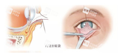 去眼袋手术图示 去眼袋手术图示