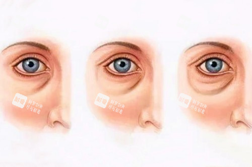 眼袋加深卡通图 眼袋加深卡通图