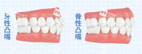 骨性凸嘴和牙性凸嘴