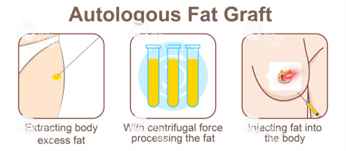 自体脂肪隆胸手术过程