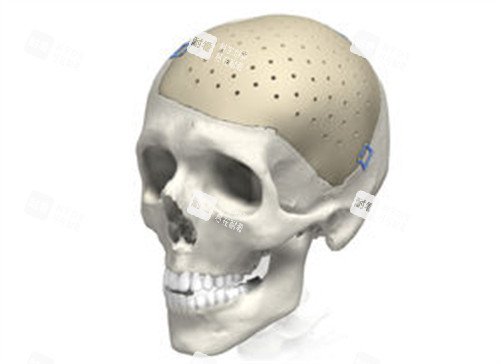 peek材料修复颅骨