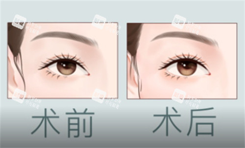 开外眼角术前术后对比