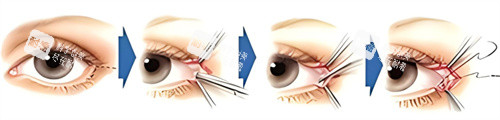 开外眼角术过程
