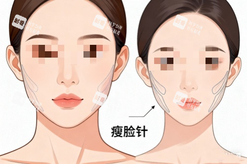 针剂注射瘦脸对比图