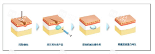 童颜针注射前后对比图解